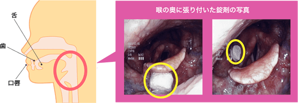 喉 に 薬 が 詰まる